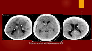 Case review ct mri brain part 3 dr ahmed esawy