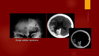 Case review ct mri brain part 3 dr ahmed esawy