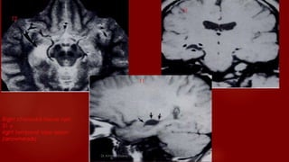 Case review ct  mri brain part 6 dr ahmed esawy