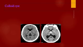 Case review ct  mri brain part 7 dr ahmed esawy