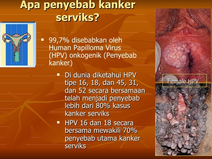 7 Faktor Penyebab Kanker Serviks Dalam Wanita 7 Faktor Penyebab Kanker Serviks Dalam Wanita