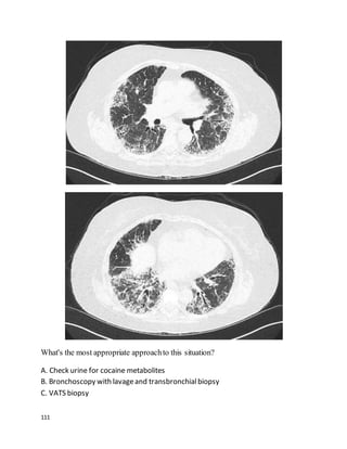 111
What's the most appropriate approachto this situation?
A. Check urine for cocaine metabolites
B. Bronchoscopy with lavageand transbronchialbiopsy
C. VATS biopsy
 