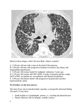 8
Based on these images, what's the most likely clinical scenario?
A. A 50-year old man with a mass in the head of the pancreas.
B. A 66-year old man with progressive dyspnea on exertion, leg edema, and
longstanding hypertension.
C. A 48-year old woman treated for malignant melanoma 2 years ago.
D. A 24-year old woman with HIV-AIDS, 4 weeks of dyspnea and dry cough,
SaO2 of 88% on ambient air, non-adherent with Bactrim prophylaxis.
E. A 60-year old chicken farmer with progressive dyspnea and a positive
hypersensitivity panel.
We feelthat A is the best answer.
The chest X-ray shows reticulonodular opacities, a nonspecific abnormal finding.
The axial CT cuts show:
 Small nodules in a lymphangitic pattern, i.e., touching the pleura/fissures
 Pleural effusions with an irregular, nodular contour
 