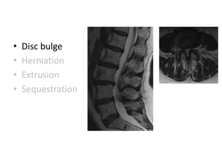 • Disc bulge
• Herniation
• Extrusion
• Sequestration
 