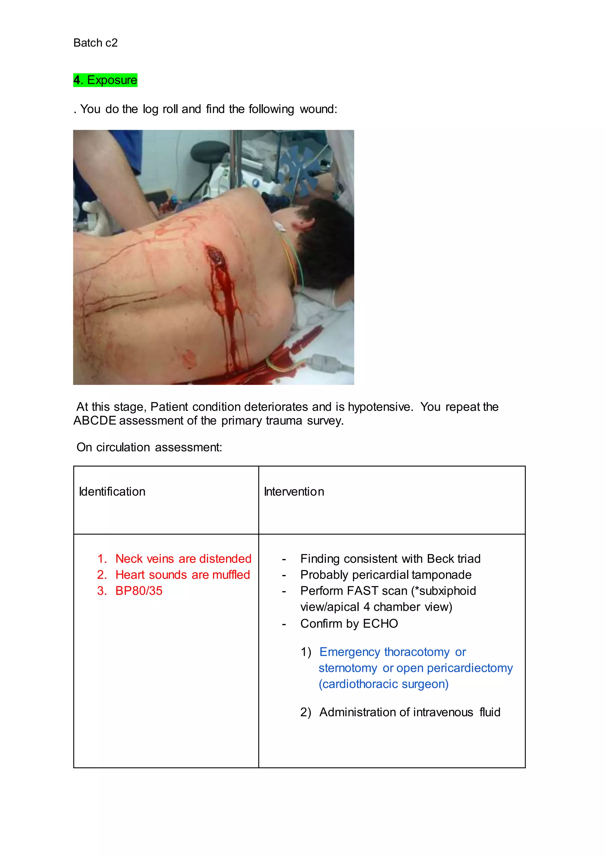 Batch c2
4. Exposure
. You do the log roll and find the following wound:
At this stage, Patient condition deteriorates and is hypotensive. You repeat the
ABCDE assessment of the primary trauma survey.
On circulation assessment:
Identification Intervention
1. Neck veins are distended
2. Heart sounds are muffled
3. BP80/35
- Finding consistent with Beck triad
- Probably pericardial tamponade
- Perform FAST scan (*subxiphoid
view/apical 4 chamber view)
- Confirm by ECHO
1) Emergency thoracotomy or
sternotomy or open pericardiectomy
(cardiothoracic surgeon)
2) Administration of intravenous fluid
 