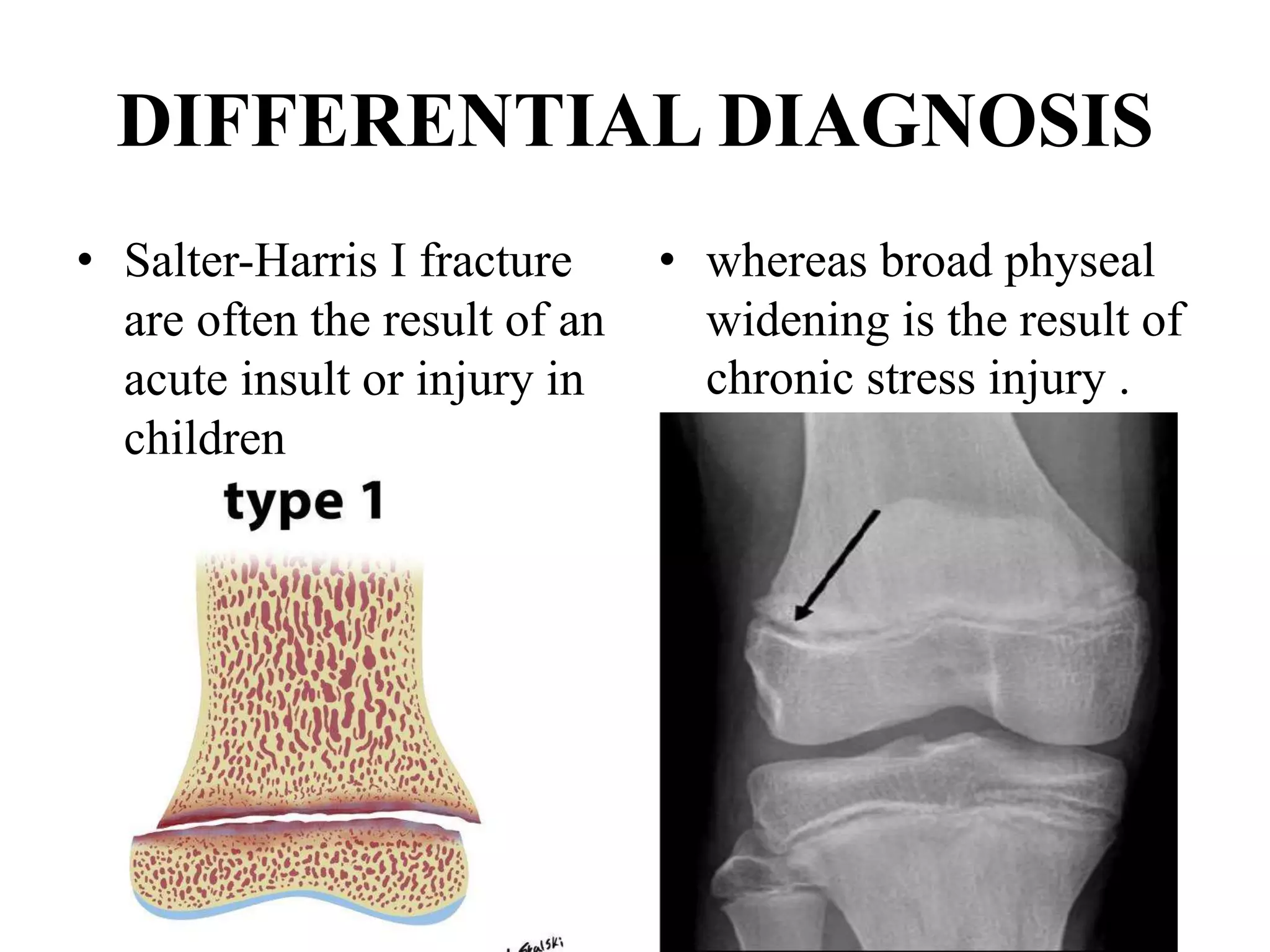 DIFFERENTIAL DIAGNOSIS
• Salter-Harris I fracture
are often the result of an
acute insult or injury in
children
•
• whereas broad physeal
widening is the result of
chronic stress injury .
 