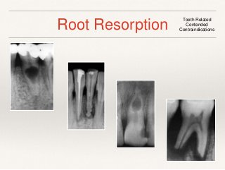 Root Resorption Tooth Related 
Contended 
Contraindications 
 
