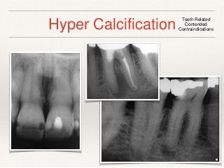 Hyper Calcification Tooth Related 
Contended 
Contraindications 
 