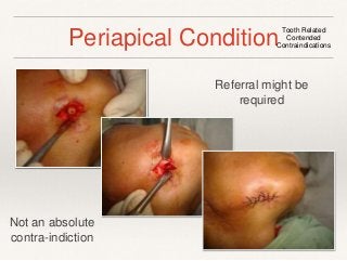 Periapical Condition Tooth Related 
Contended 
Contraindications 
Referral might be 
required 
Not an absolute 
contra-indiction 
 