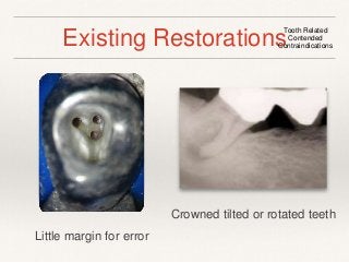 Existing RestorationsTooth Related 
Contended 
Contraindications 
Crowned tilted or rotated teeth 
Little margin for error 
 