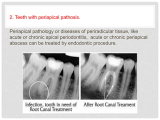 2. Teeth with periapical pathosis.
Periapical pathology or diseases of periradicular tissue, like
acute or chronic apical periodontitis, acute or chronic periapical
abscess can be treated by endodontic procedure.
 