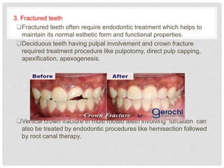 3. Fractured teeth
Fractured teeth often require endodontic treatment which helps to
maintain its normal esthetic form and functional properties.
Deciduous teeth having pulpal involvement and crown fracture
required treatment procedure like pulpotomy, direct pulp capping,
apexification, apexogenesis.
Vertical crown fracture in multi rooted teeth involving furcation can
also be treated by endodontic procedures like hemisection followed
by root canal therapy.
 