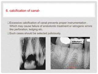 6. calcification of canal-
Excessive calcification of canal prevents proper instrumentation .
Which may cause failure of endodontic treatment or iatrogenic errors
like perforation, ledging etc.
Such cases should be selected judiciously.
 