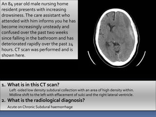 An 84 year old male nursing home
resident presents with increasing
drowsiness.The care assistant who
attended with him informs you he has
become increasingly unsteady and
confused over the past two weeks
since falling in the bathroom and has
deteriorated rapidly over the past 24
hours. CT scan was performed and is
shown here.
1. What is in this CT scan?
Left -sided low density subdural collection with an area of high density within.
Midline shift to the left with effacement of sulci and the right lateral ventricle.
2. What is the radiological diagnosis?
Acute on Chronic Subdural haemorrhage
 