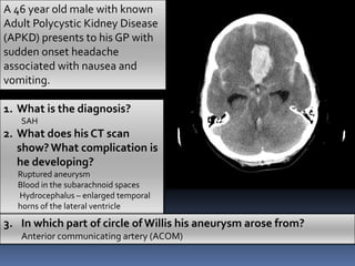 A 46 year old male with known
Adult Polycystic Kidney Disease
(APKD) presents to his GP with
sudden onset headache
associated with nausea and
vomiting.
1. What is the diagnosis?
SAH
2. What does his CT scan
show?What complication is
he developing?
Ruptured aneurysm
Blood in the subarachnoid spaces
Hydrocephalus – enlarged temporal
horns of the lateral ventricle
3. In which part of circle of Willis his aneurysm arose from?
Anterior communicating artery (ACOM)
 