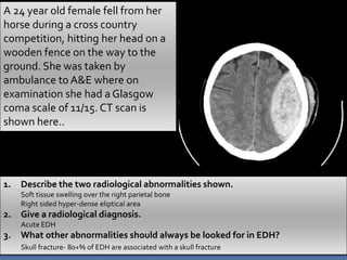 A 24 year old female fell from her
horse during a cross country
competition, hitting her head on a
wooden fence on the way to the
ground. She was taken by
ambulance to A&E where on
examination she had a Glasgow
coma scale of 11/15. CT scan is
shown here..
1. Describe the two radiological abnormalities shown.
Soft tissue swelling over the right parietal bone
Right sided hyper-dense eliptical area
2. Give a radiological diagnosis.
Acute EDH
3. What other abnormalities should always be looked for in EDH?
Skull fracture- 80+% of EDH are associated with a skull fracture
 