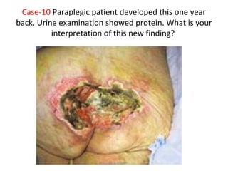 Case-10 Paraplegic patient developed this one year
back. Urine examination showed protein. What is your
interpretation of this new finding?
Dec-2016-CSBRP
 