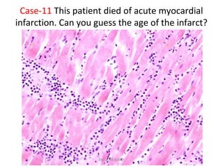 Case-11 This patient died of acute myocardial
infarction. Can you guess the age of the infarct?
Dec-2016-CSBRP
 