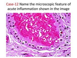 Case-12 Name the microscopic feature of
acute inflammation shown in the image
Dec-2016-CSBRP
 