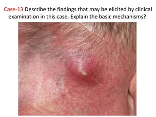 Case-13 Describe the findings that may be elicited by clinical
examination in this case. Explain the basic mechanisms?
Dec-2016-CSBRP
 