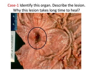 Case-1 Identify this organ. Describe the lesion.
Why this lesion takes long time to heal?
Dec-2016-CSBRP
 