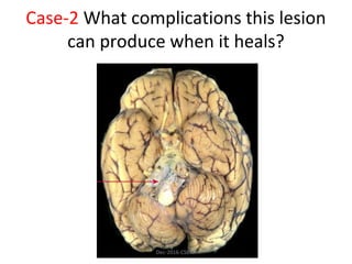 Case-2 What complications this lesion
can produce when it heals?
Dec-2016-CSBRP
 