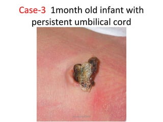 Case-3 1month old infant with
persistent umbilical cord
Dec-2016-CSBRP
 
