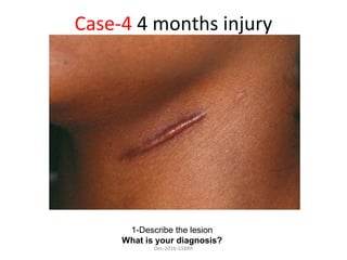 Case-4 4 months injury
1-Describe the lesion
What is your diagnosis?
Dec-2016-CSBRP
 