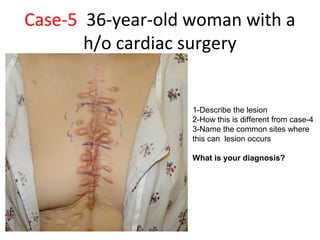 Case-5 36-year-old woman with a
h/o cardiac surgery
1-Describe the lesion
2-How this is different from case-4
3-Name the common sites where
this can lesion occurs
What is your diagnosis?
Dec-2016-CSBRP
 