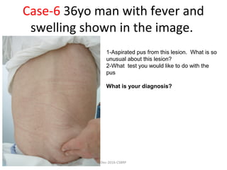 Case-6 36yo man with fever and
swelling shown in the image.
1-Aspirated pus from this lesion. What is so
unusual about this lesion?
2-What test you would like to do with the
pus
What is your diagnosis?
Dec-2016-CSBRP
 