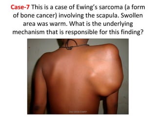 Case-7 This is a case of Ewing’s sarcoma (a form
of bone cancer) involving the scapula. Swollen
area was warm. What is the underlying
mechanism that is responsible for this finding?
Dec-2016-CSBRP
 