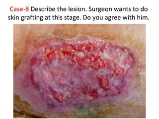 Case-8 Describe the lesion. Surgeon wants to do
skin grafting at this stage. Do you agree with him.
Dec-2016-CSBRP
 