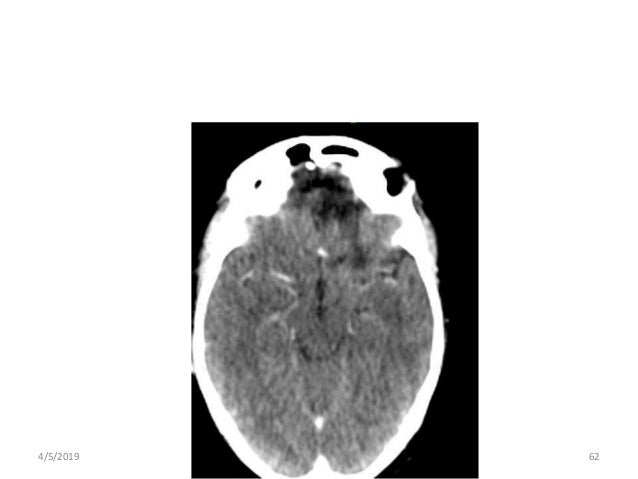 Benign tumor on pituitary gland image