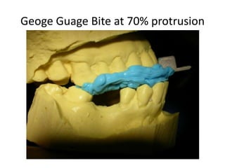 Geoge Guage Bite at 70% protrusion
 