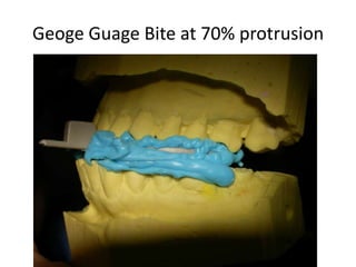 Geoge Guage Bite at 70% protrusion
 