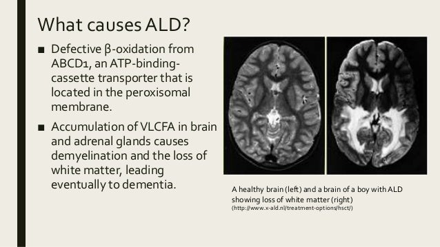 ALD Case study