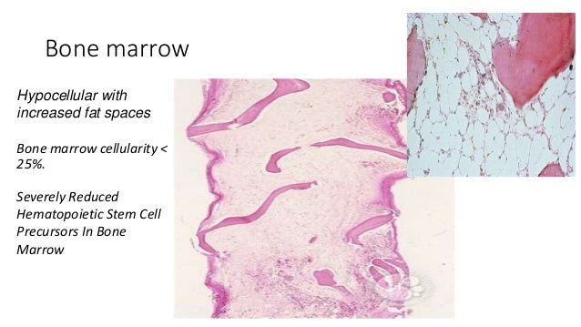 Case Study - Aplastic Anemia