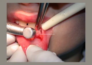 Quiste salival láser