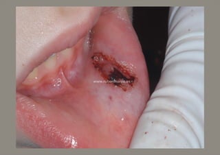 Quiste salival láser