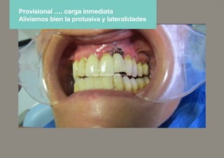 Provisional …. carga inmediata
Aliviamos bien la protusiva y lateralidades
 