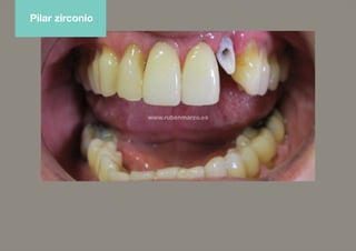 Pilar zirconio
 