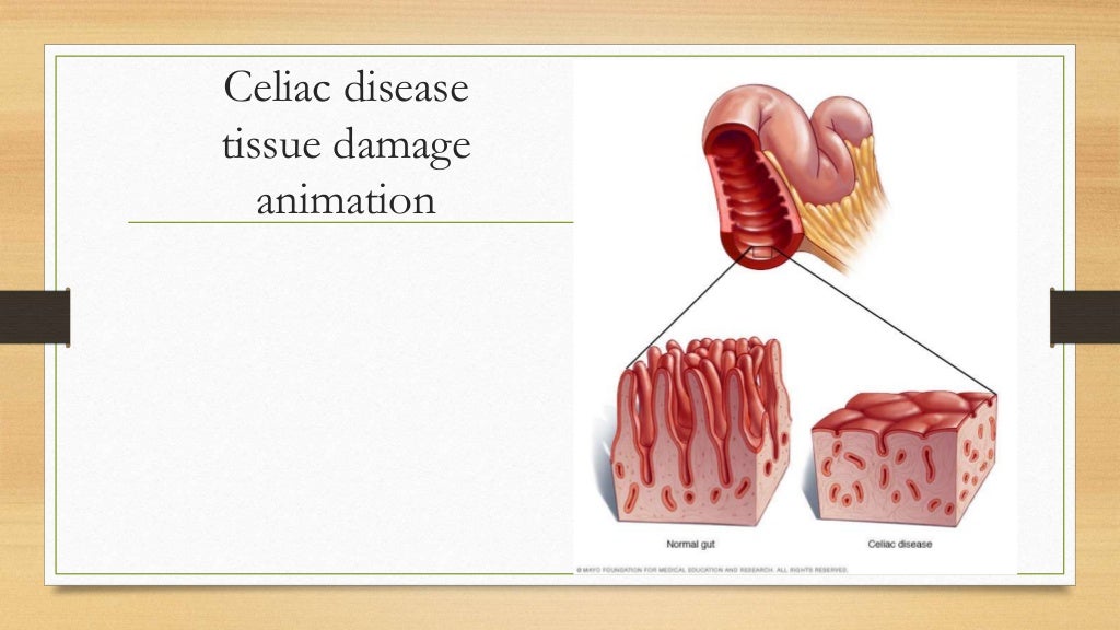 case study celiac disease quizlet