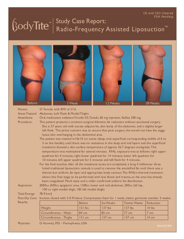 Study Case Report:
Radio-Frequency Assisted Liposuction™
Patient: 57 Female with BMI of 27.6
Areas Treated: Abdomen, Left Flank & Medial Thighs
Anesthesia: Oral medication sedation:Vicodin ES,Torado 60 mg injection, Keﬂex 500 mg
Procedure: This patient presents a common surgical dilemma: fat reduction without excisional surgery.
She is 57 years old with excess adipose fat, skin laxity of the abdomen, and a slightly larger
left ﬂank. The prime concern was to ensure that post surgery she would not have the saggy
loose skin overhanging in the abdominal area.
The patient was treated in10x10 cm zones (deep, mid, superﬁcial; corresponding widths of 6 to
3 on the handle), until there was no resistance in the deep and mid layers and the superﬁcial
treatment showed a skin surface temperature of approx 36.7 degrees centigrade.This
temperature was maintained for several minutes. RFAL exposure was as follows: right upper
quadrant for 4 minutes, right lower quadrant for 14 minutes, lower left quadrant for
10 minutes, left upper quadrant for 5 minutes and left ﬂank for 4 minutes.
For the ﬁnal touches after all the treatment zones are completed, a long 4 millimeter three
holed traditional liposuction cannula is used to remove the emulsiﬁed fat until there was a
thinner, but uniform, fat layer and appropriate body contour.The RFAL’s thermal treatment
allows this ﬁnal stage to be performed with less blood and trauma, as the area has already
been coagulated. Pinch tests and a roller conﬁrmed uniform fat distribution.
Aspiration: 2000cc (400cc epigastric area, 1200cc lower and mid abdomen, 200cc left hip,
100 cc right medial thigh, 100 left medial thigh)
Total Energy: 78.9 km/J
Post-Op Care: Incision closed with 3-0 Prolene. Compression foam for 1 week, elastic garments another 3 weeks.
Results:
Physician: D. Hurwitz, MD - Pennsylvania, USA
DH.4.57.PH
CE and ISO Cleared
FDA Pending
18 Weeks
1 Week
Before 12 Weeks
Before Six Weeks Twelve Weeks Reduction
Weight 151 lbs 137 lbs 137 lbs 14 lbs
Circumference - Waist 84 cm 85 cm 77 cm 7 cm
Circumference - Thighs 151 cm 137 cm 137 cm 14 cm
 