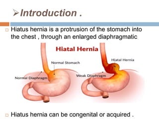 Hiatus hernia case study image
