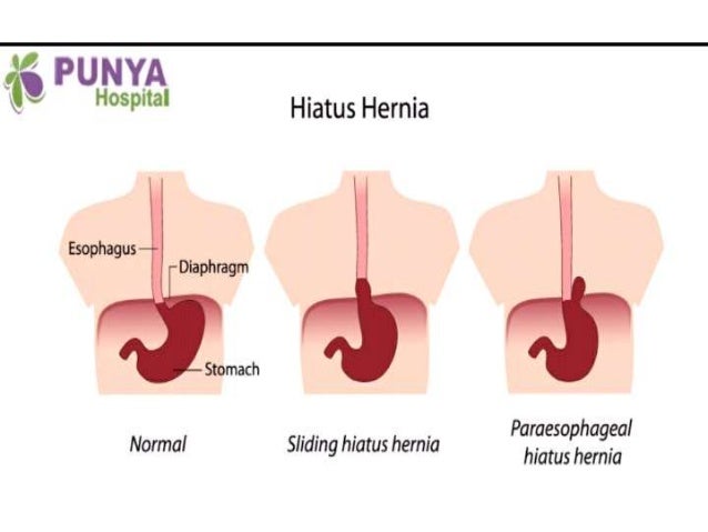 Hiatal hernia uptodate image