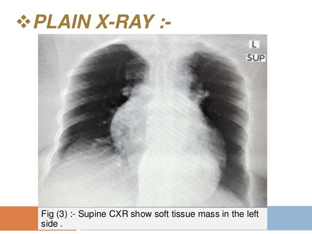 Irregular z-line hiatal hernia image