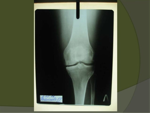 Does osteoarthritis spread picture