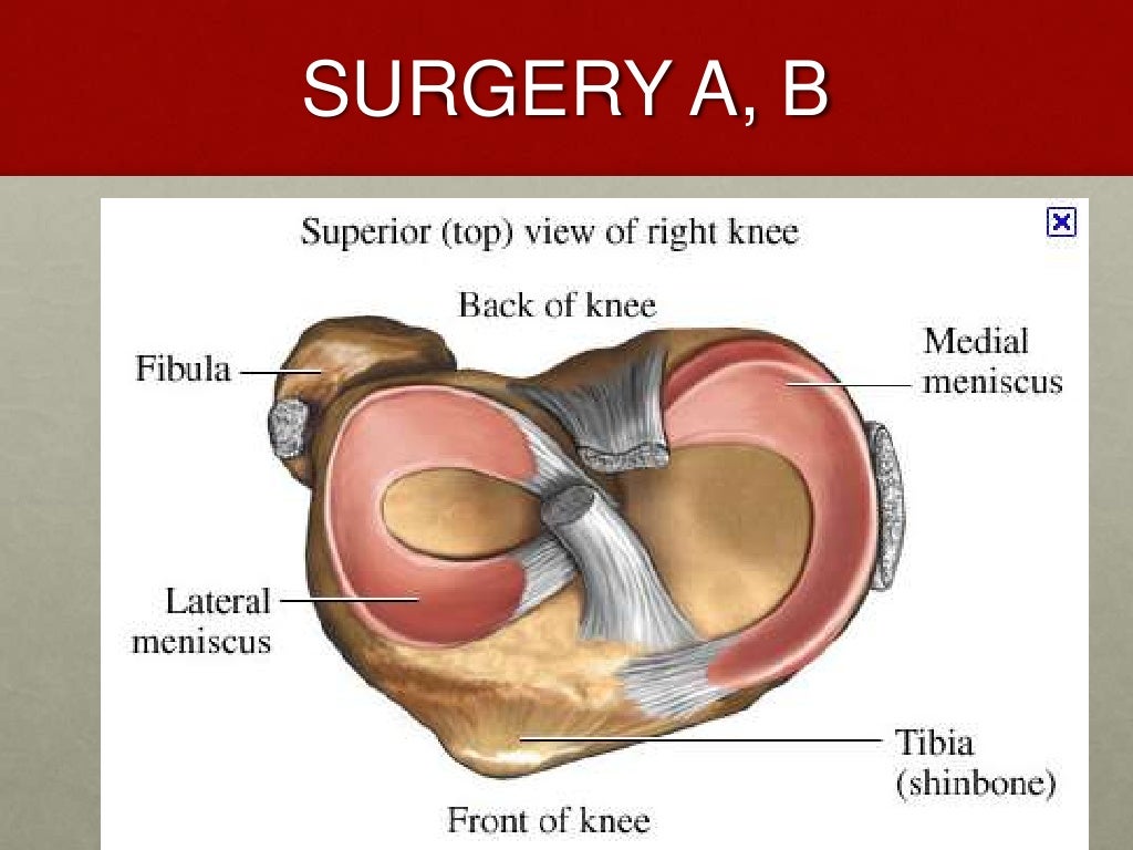 Picture of a torn meniscus picture