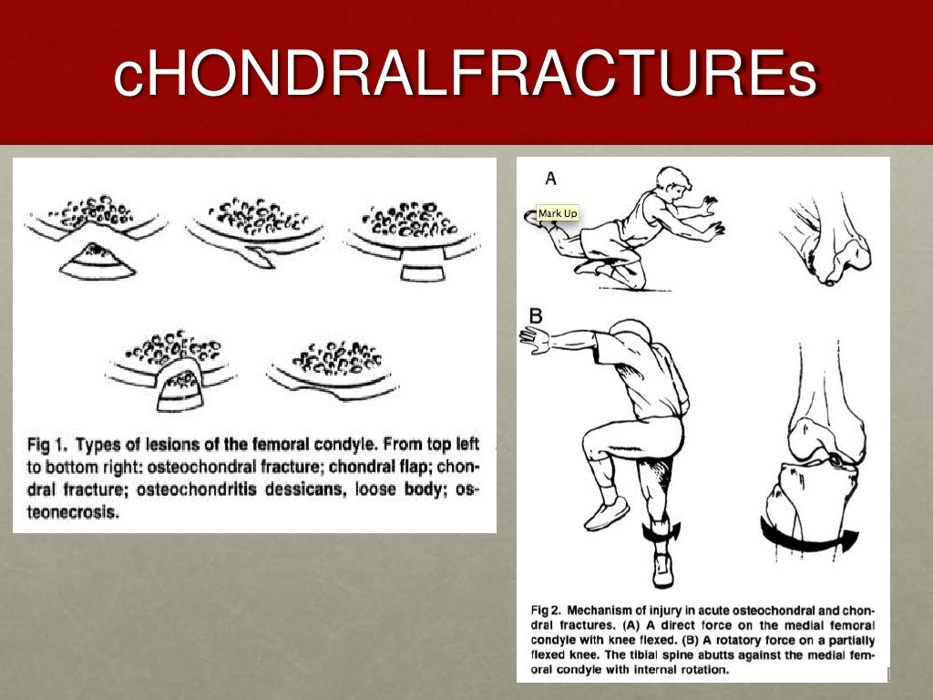 Bilateral meniscus tear picture