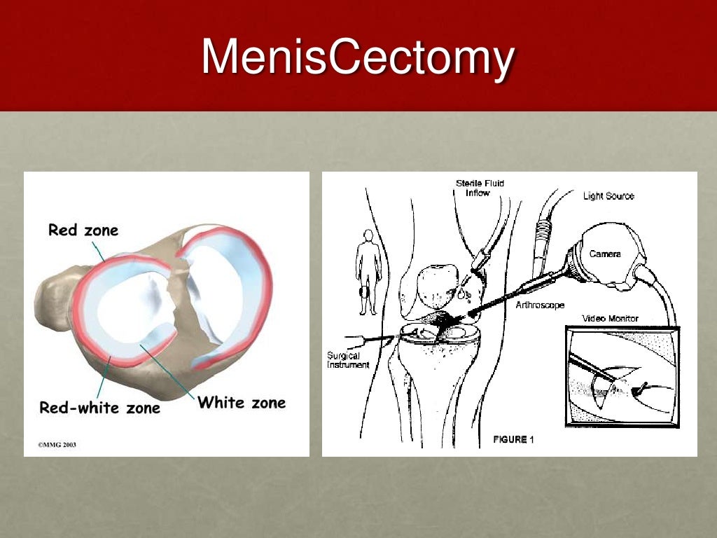 Medial meniscus tear case study picture